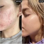 تاثیرات سرم نیاسینامید ۱۰٪ + زینک ۱٪ اوردینری